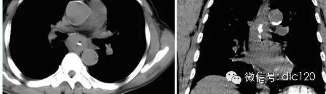 食管癌--X线钡餐-CT病例图片影像诊断分析