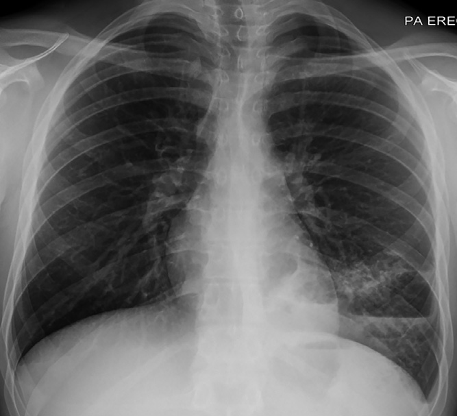 临床思维：19岁男孩肺部空洞性病变原因为何？︱病例学习
