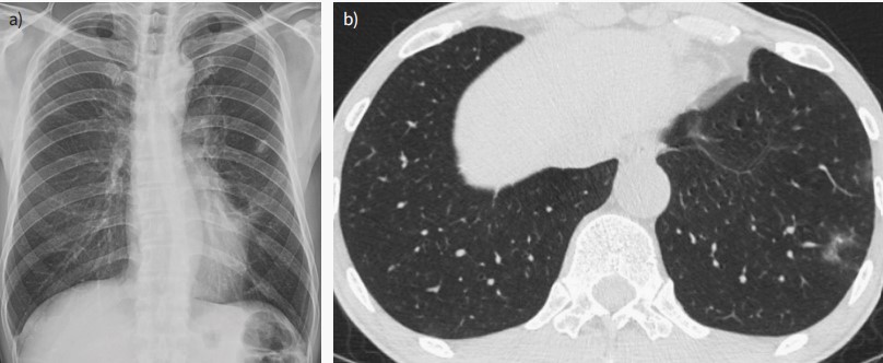 一文盘点：肺寄生虫病的临床表现