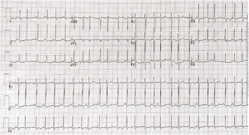 翻译-Dysrhythmias associated with COVID14788.png