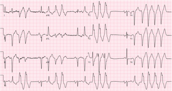 翻译-Dysrhythmias associated with COVID18947.png