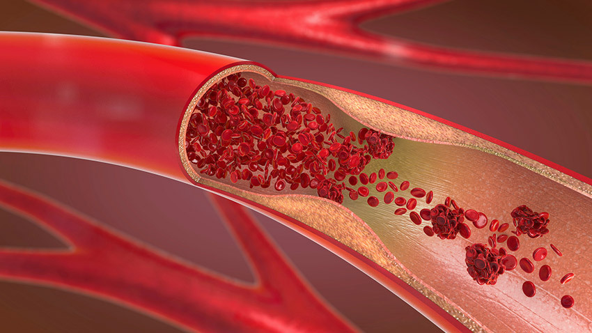 vein red blood cells plaque