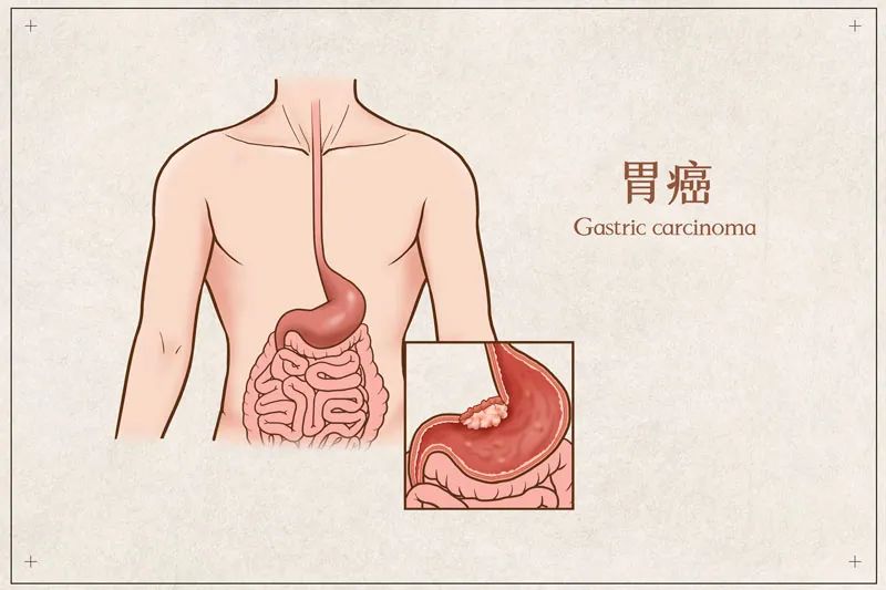 胃最怕这几件事，多占一个离胃癌近一分！医生：很多人一确诊就是晚期