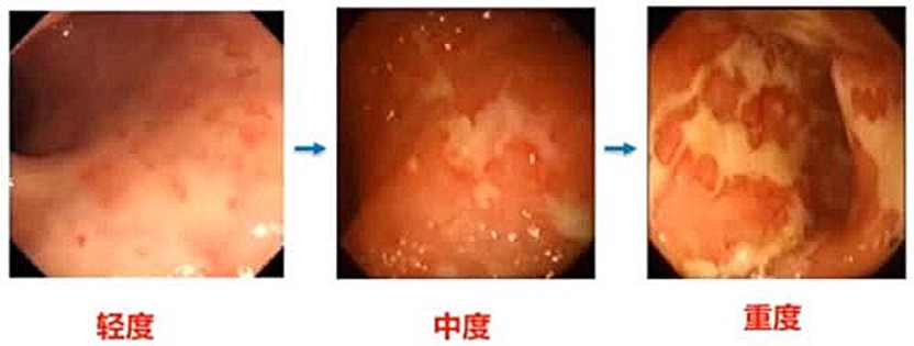 吴开春教授：溃疡性结肠炎诊治新视角 | CGC 2022