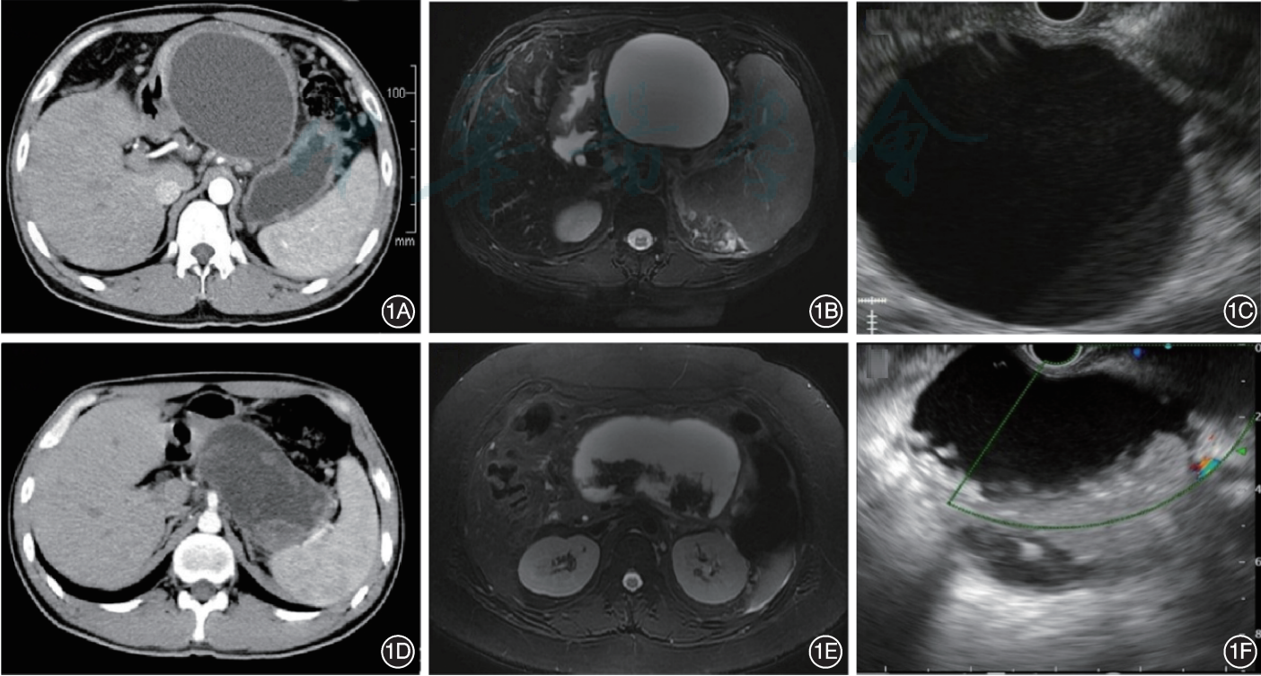 一文“get”胰腺假性囊肿的诊疗丨临床必备