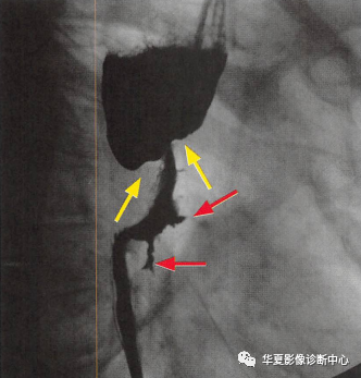 黑色玫瑰征，你知道吗？