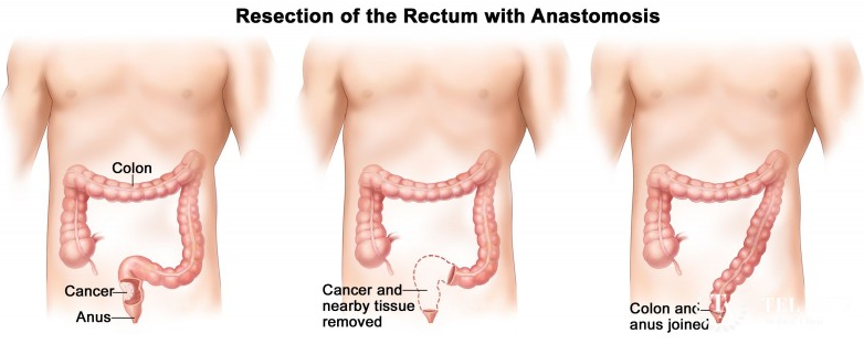 直肠癌怎么治疗？如何在“保命”的基础上实现“保肛”？