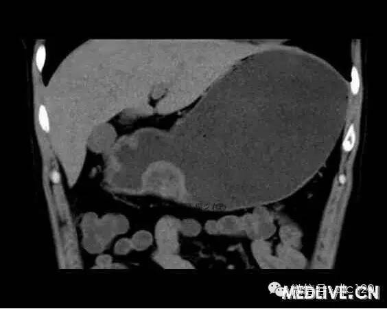 【病例】 胃异位胰腺