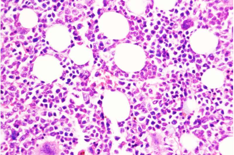 Nature子刊：慢性血癌转变为侵袭性疾病的关键