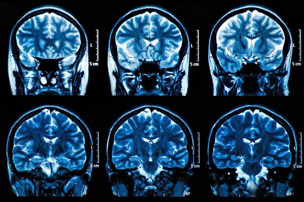 MRI Brain Scan Neuroscience Images